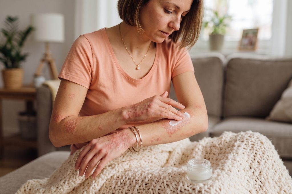 Túl a viszketésen: Mi történik valójában az ekcémás bőrrel? 1 atópiás dermatitisz