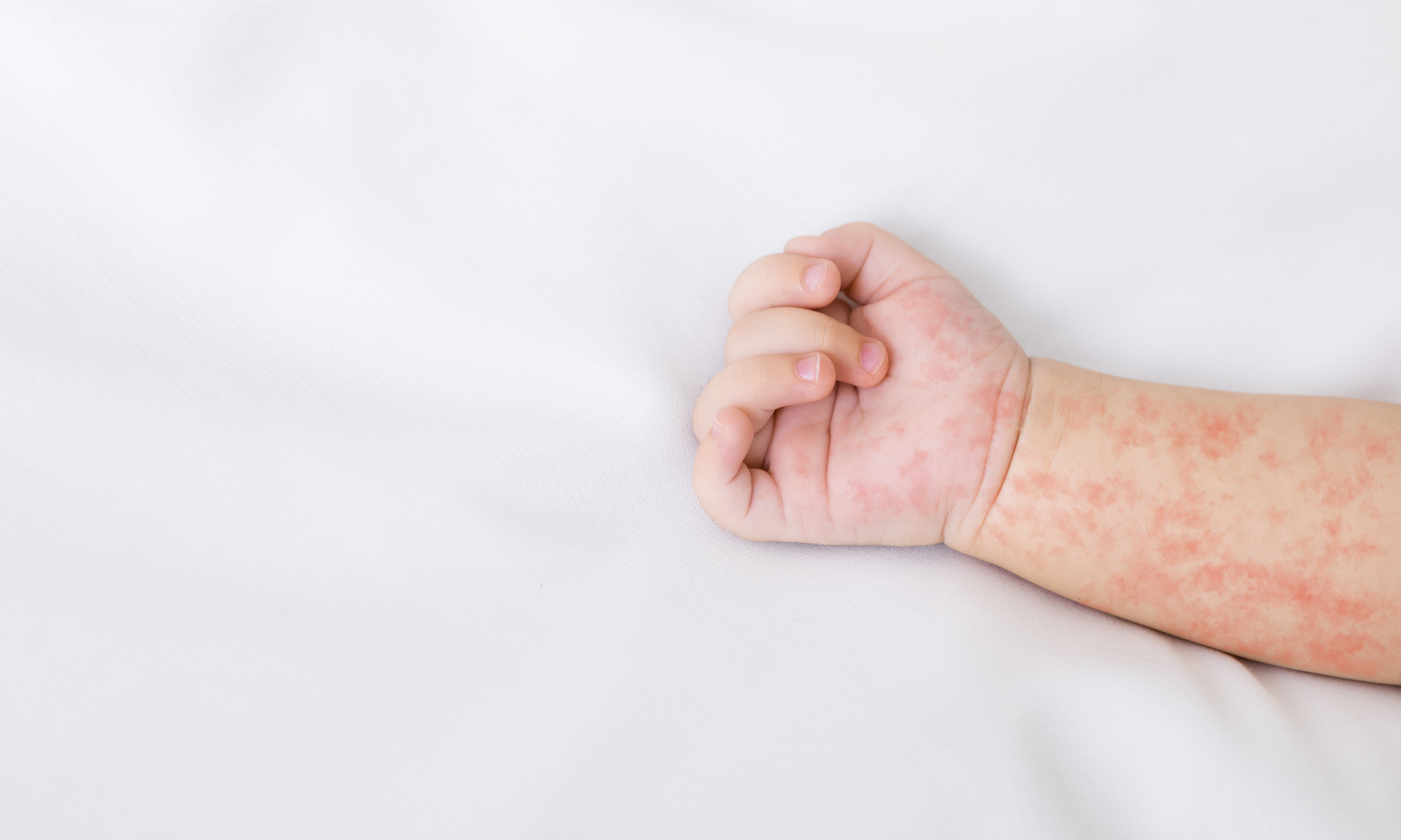 Több mint bőrkiütés – az ekcéma lelki háttere és a táplálkozás Az atópiás dermatitisz (ekcéma) egy krónikus gyulladásos betegség, amelyet legtöbbször a bőr különböző pontjain megjelenő piros, viszkető kiütések kísérnek. Kialakulásában genetikai, immunológiai, valamint környezeti tényezők egyaránt szerepet játszanak.Bár a betegség főként a gyermekeknél áll fenn, a felnőttek körében is egyre gyakoribb a megjelenése – Magyarországon a felnőttek 5 százalékát, vagyis közel félmillió embert érint.Az előző cikkünkben körbejártuk az ekcéma biológiai hátterét, valamint a fizikai tüneteket. A tudomány azonban igazolja, hogy ha elszigetelt szervként tekintünk a bőrre, azzal könnyen csapdába csaljuk magunkat. A testünkben a szervrendszerek ugyanis szorosan összefüggnek és hatással vannak egymásra. Ekcéma esetén az idegrendszer, a hormonháztartás és az emésztőrendszer finomhangolása nélkül a barrier helyreállítása csak félmegoldás. Ha a tartós enyhülés a cél, valódi áttörést hozhat az ekcéma kezelése természetesen és holisztikusan.